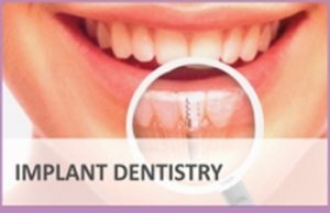 Implant Dentistry Dental Clinic Mumbai