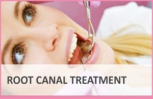 Root Canal Treatment Dental Clinic Mumbai