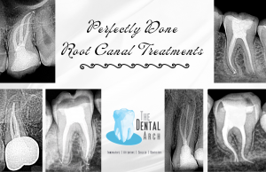 Root Canal Treatments in India