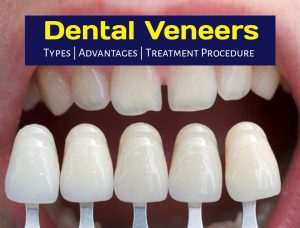 Types of Dental Veneers in India