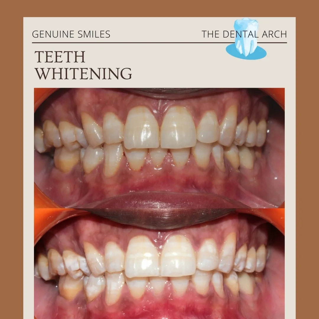 Teeth Whitening Banner