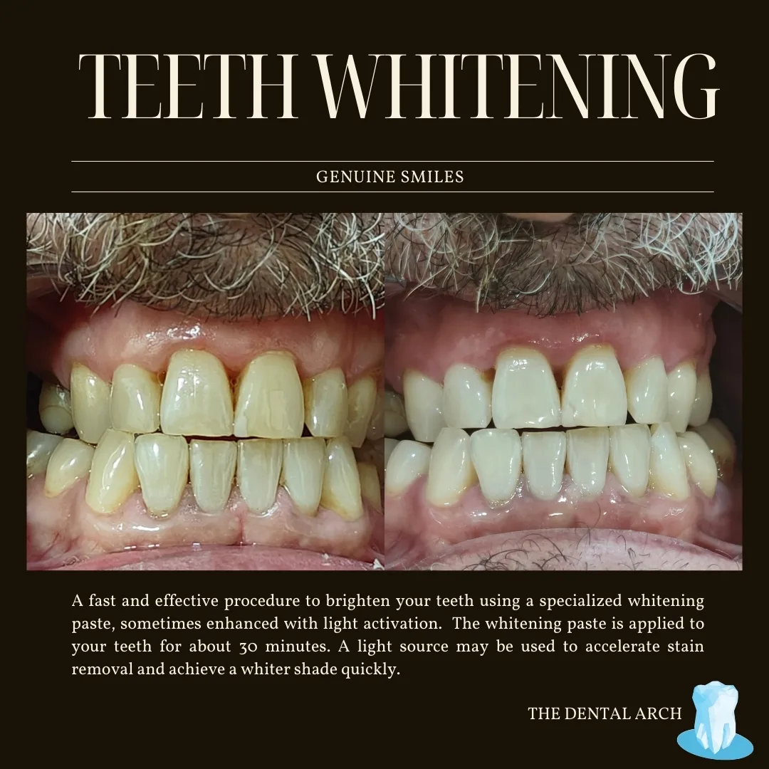 Teeth Whitening Banner