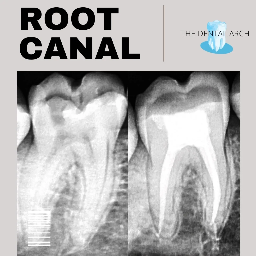 Root Canal Treatment Banner