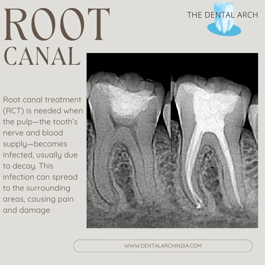 Root Canal Treatment Banner