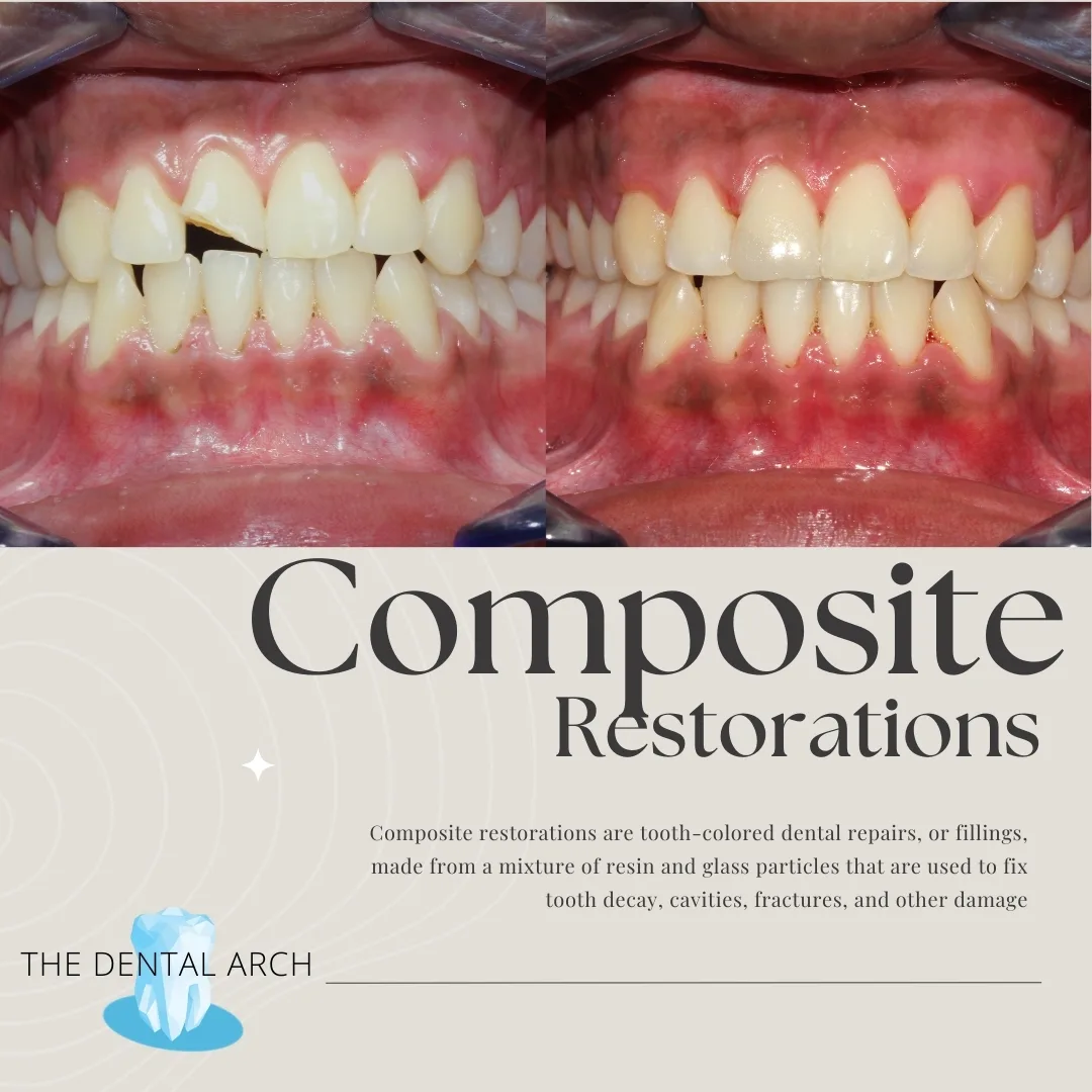 Composite Restoration Banner