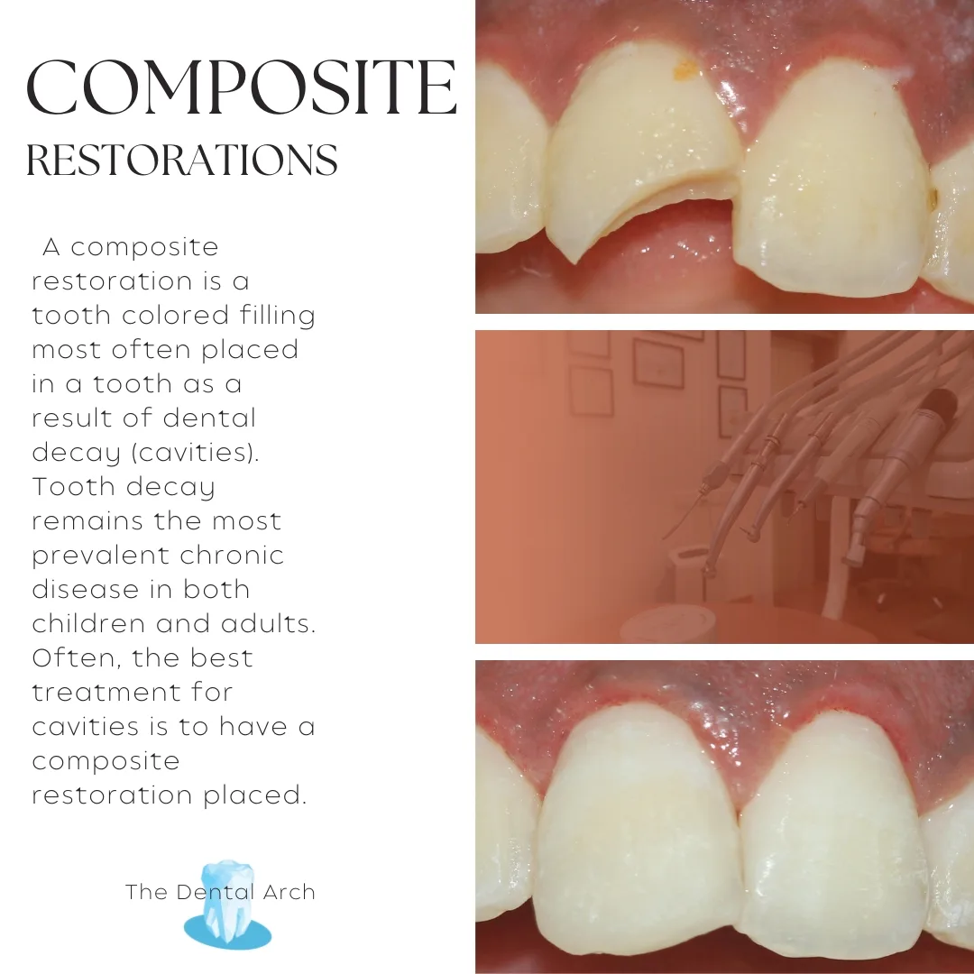 Composite Restoration Banner