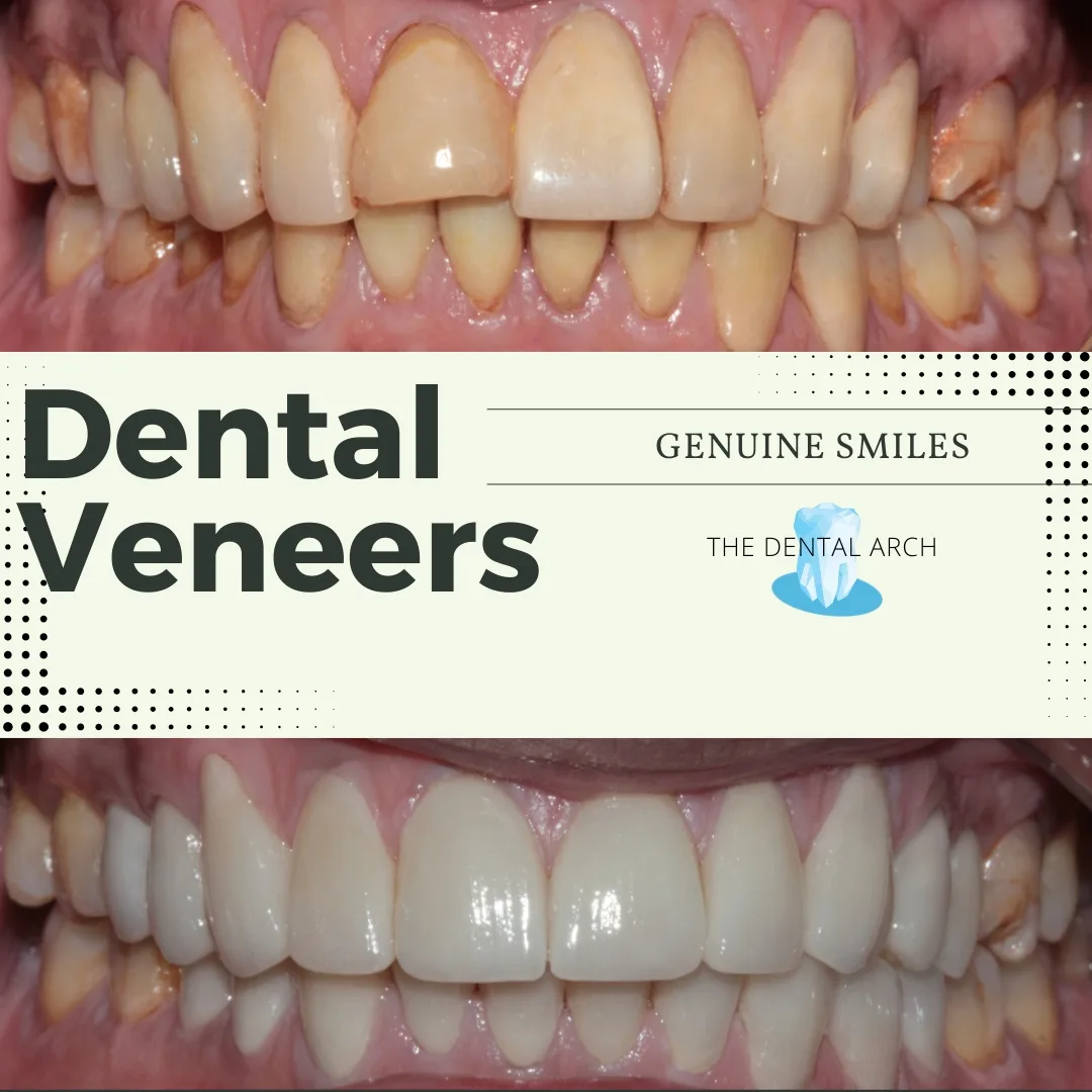 Dental Veneers banner