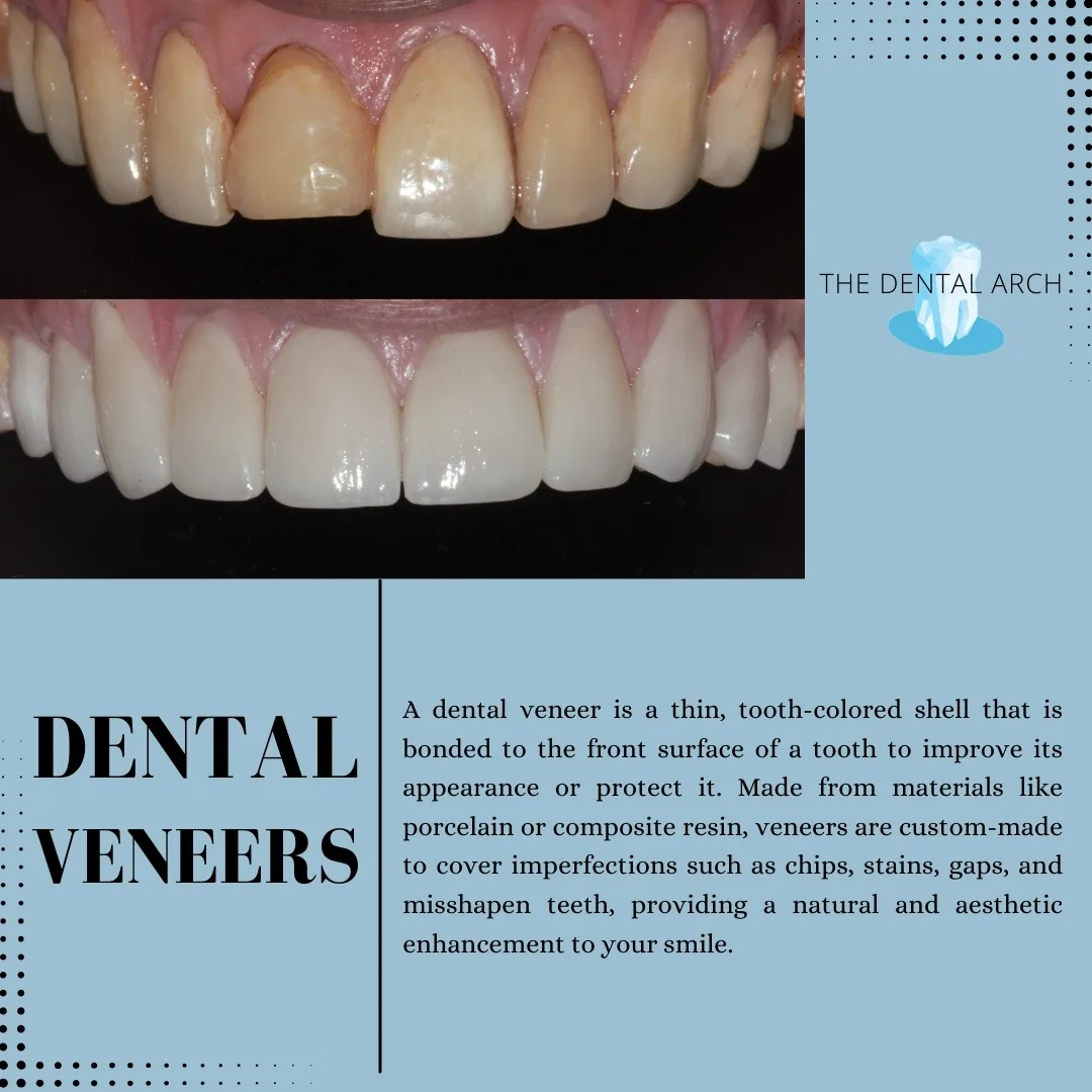 Dental Veneers banner