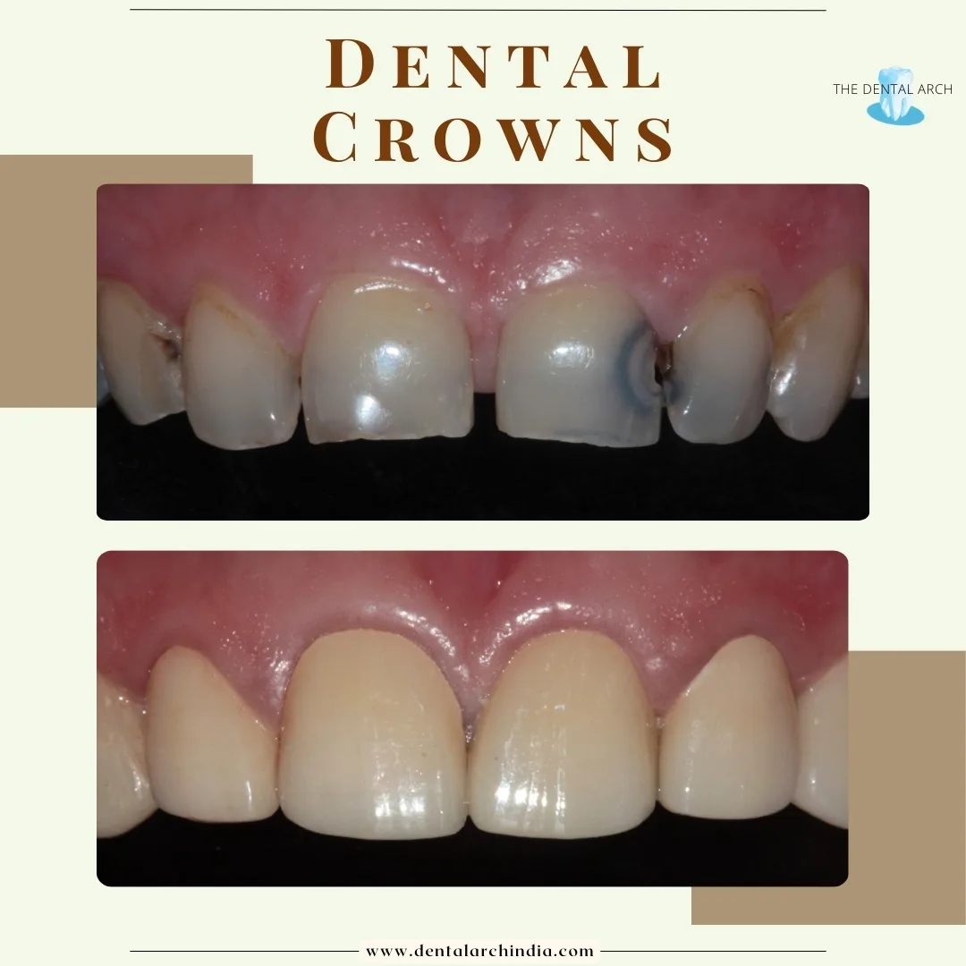 Dental Crowns Banner