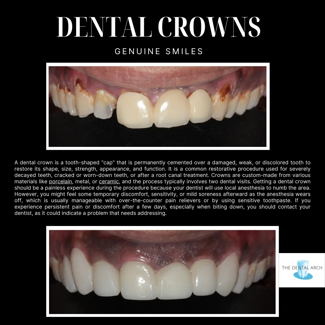 Dental Crowns Banner