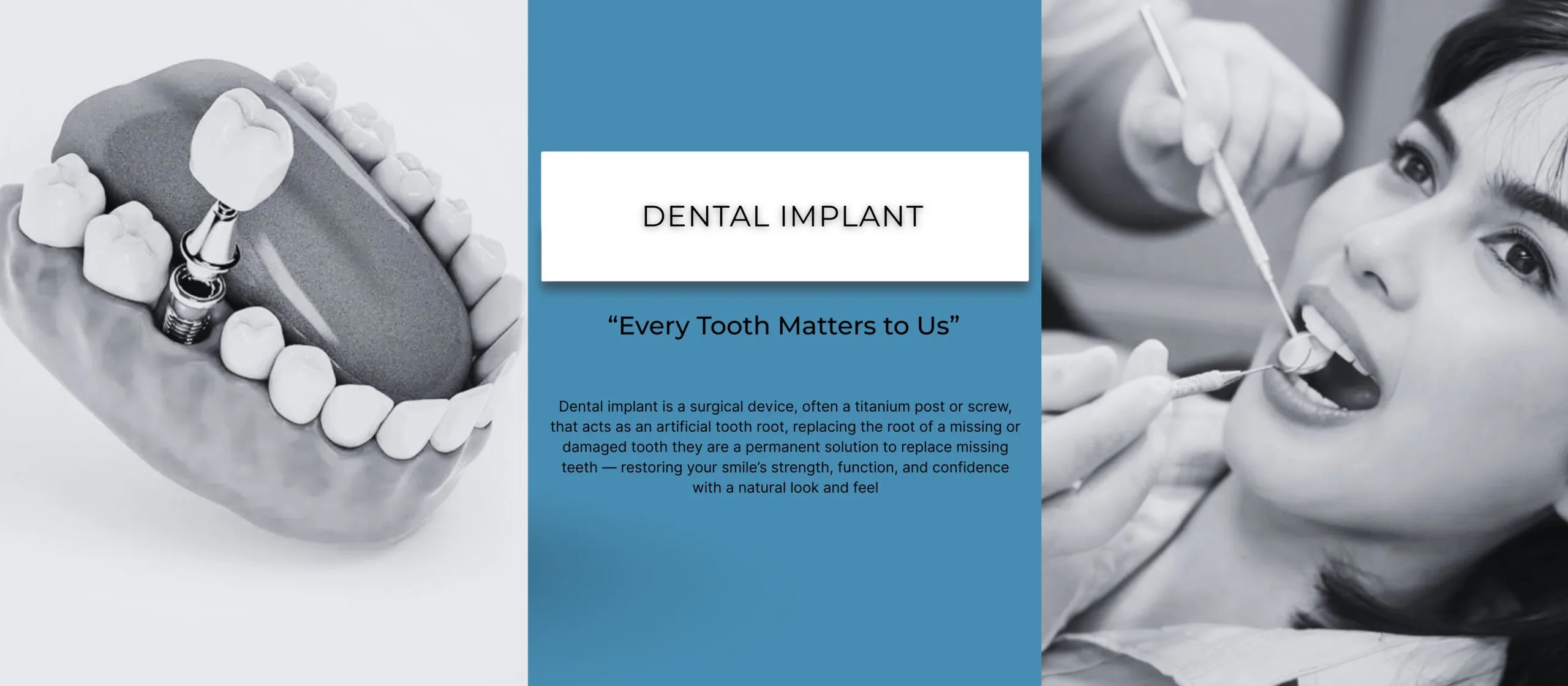 Dental Implant - Every Tooth Matters to Us