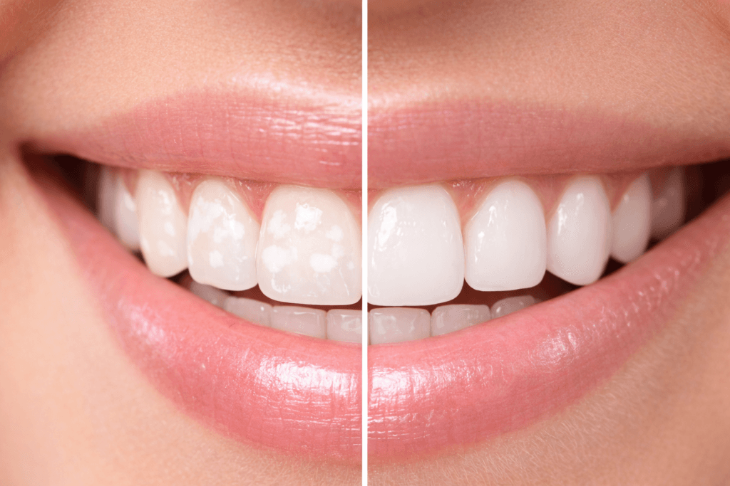 teeth before and after treatment for white spots
