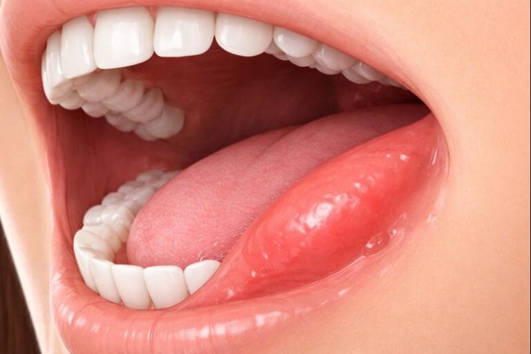 Mouth Swelling Inside Cheek