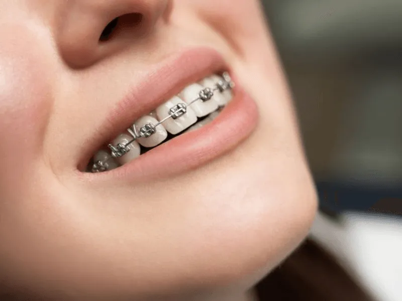 Orthodontics in Bandra