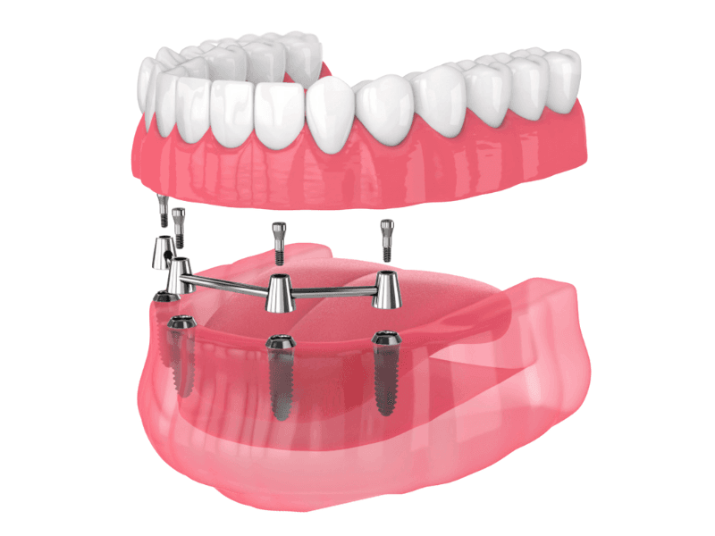 4 dental implants in bandra