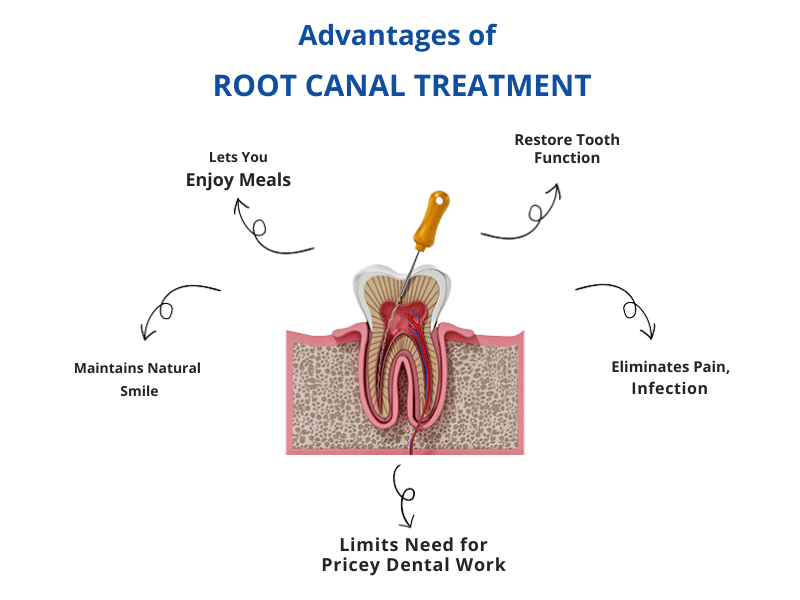 Advantages of Root Canal Treatment