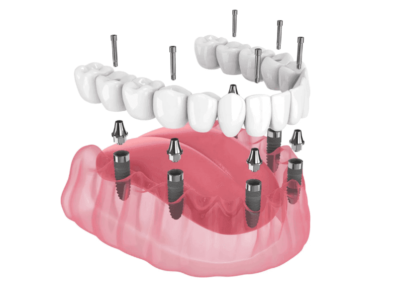 All on 6 Implants