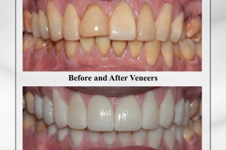 Before and After Veneers