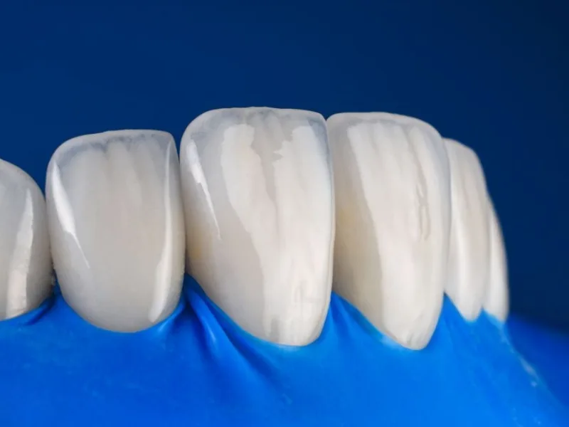 Composite Veneers in mumbai