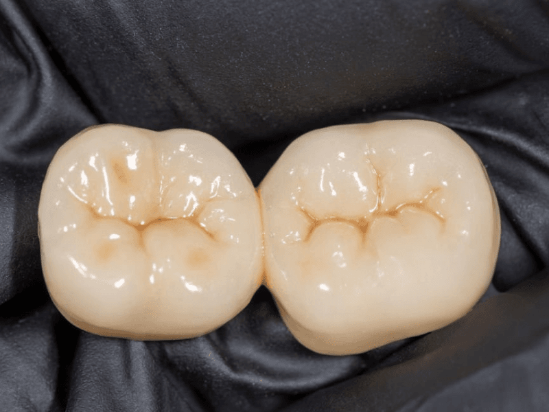 Crown Placement After Root Canal