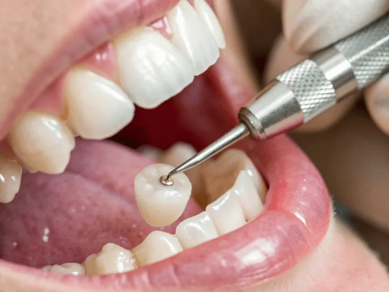 Dental Crowns Treatment