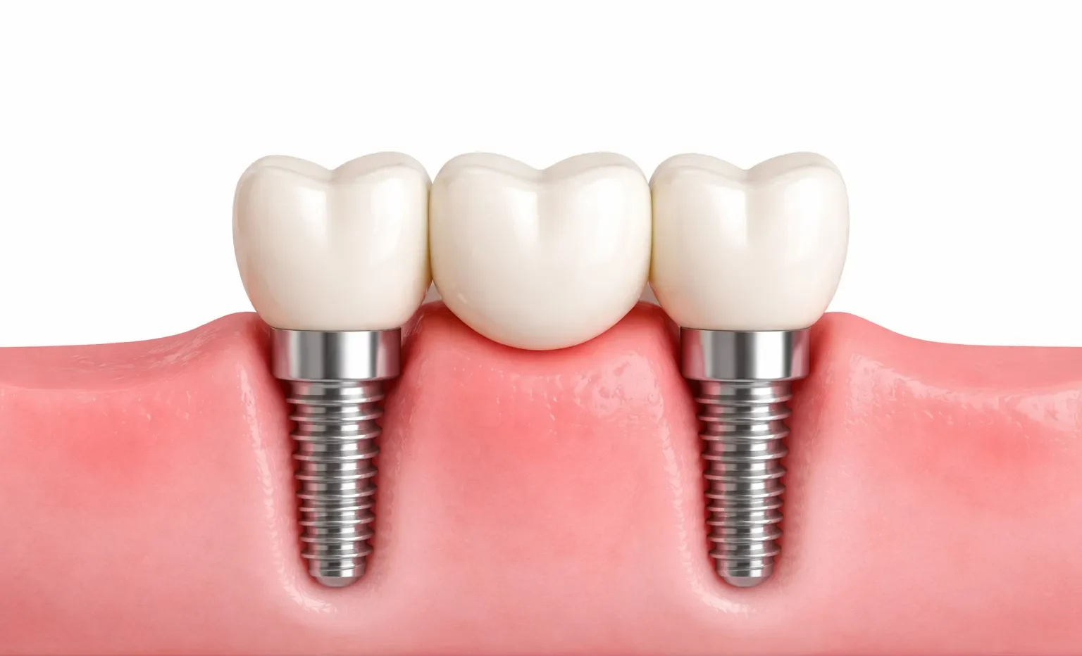 Multiple Tooth Implants