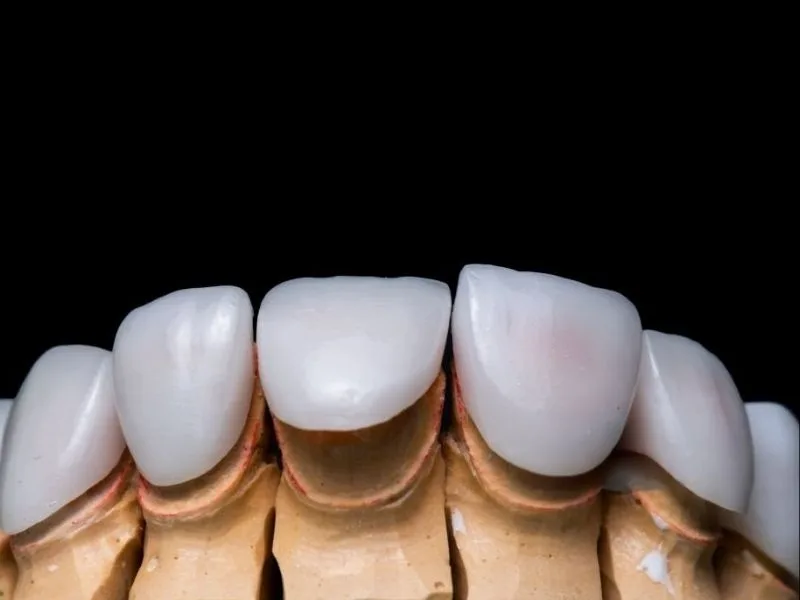Porcelain Veneers in mumbai