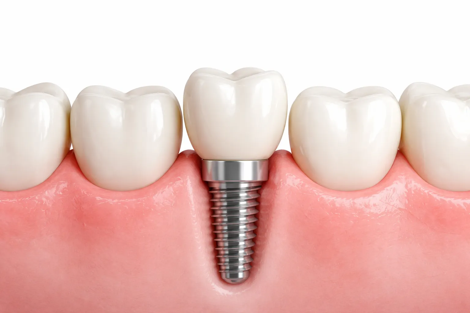 Single Tooth Implant