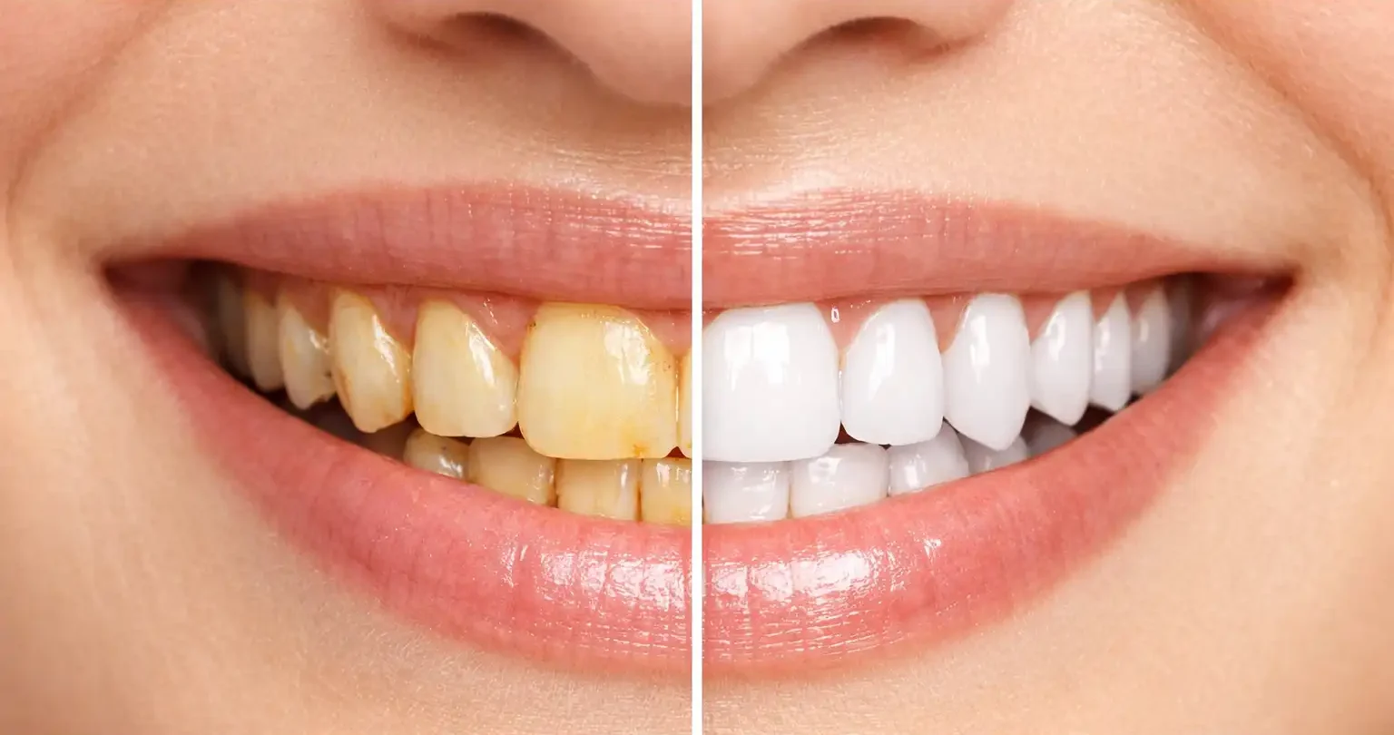 Teeth Whitening in Mumbai
