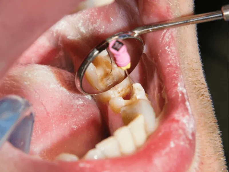 What Causes Teeth Staining