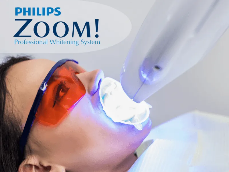 Zoom teeth whitening in Bandra.