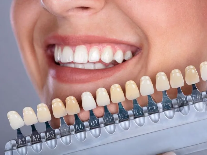 dental bleaching