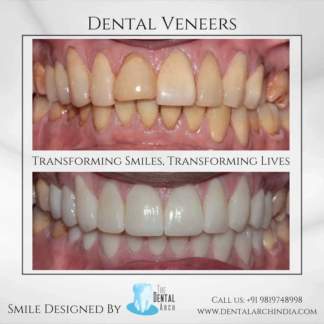 veneers before after smile transformation