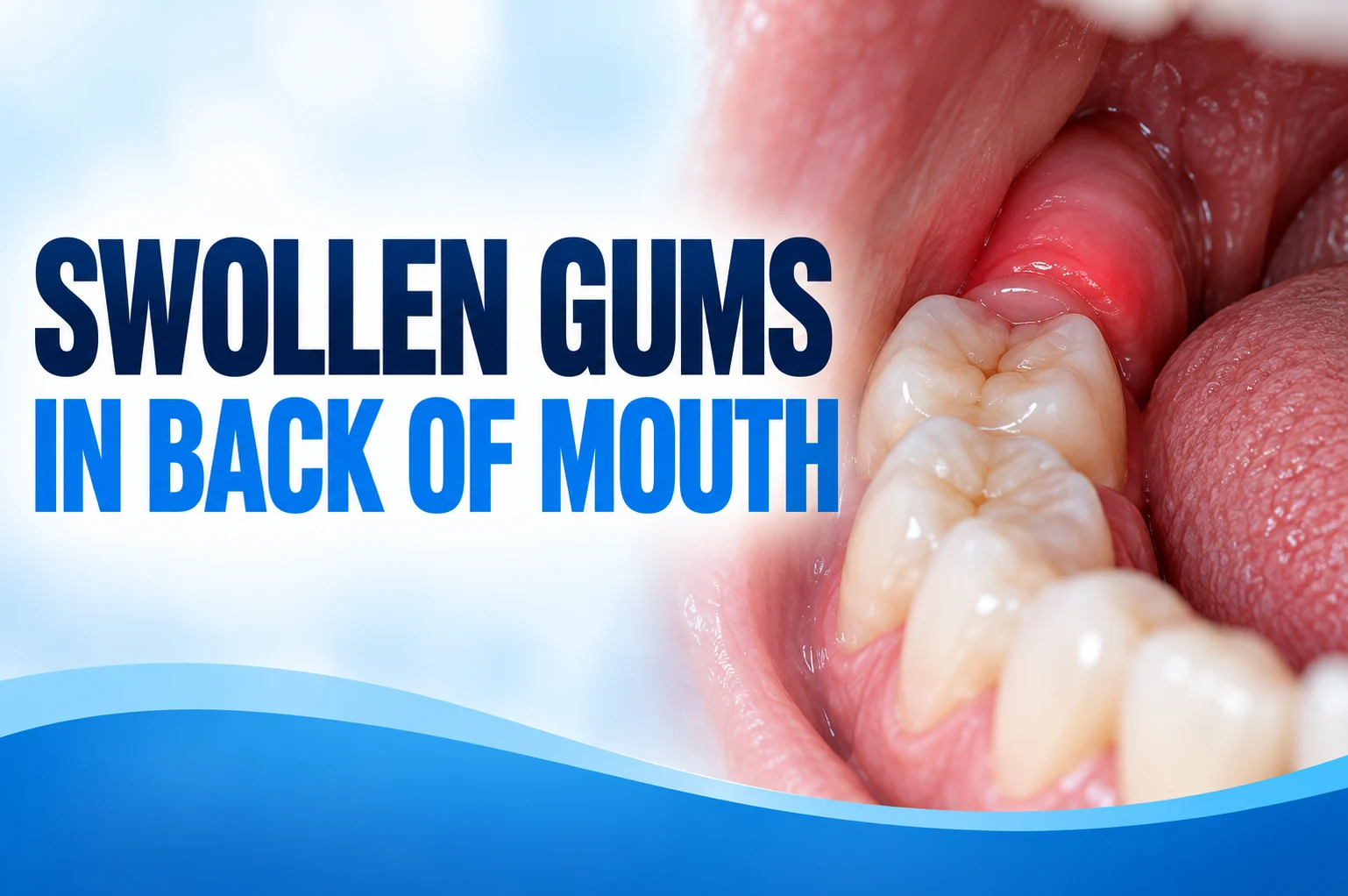 Swollen gums in back of mouth
